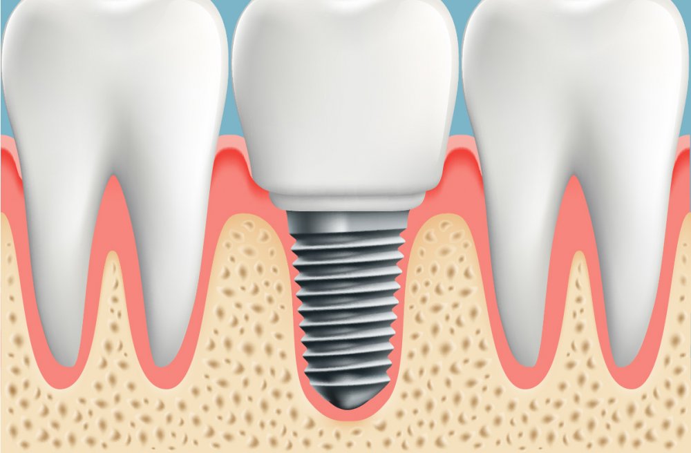 İMPLANT TEDAVİSİ